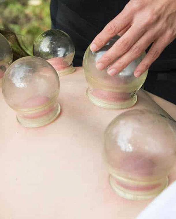Fire Cupping therapy at Acupuncture Center Toronto