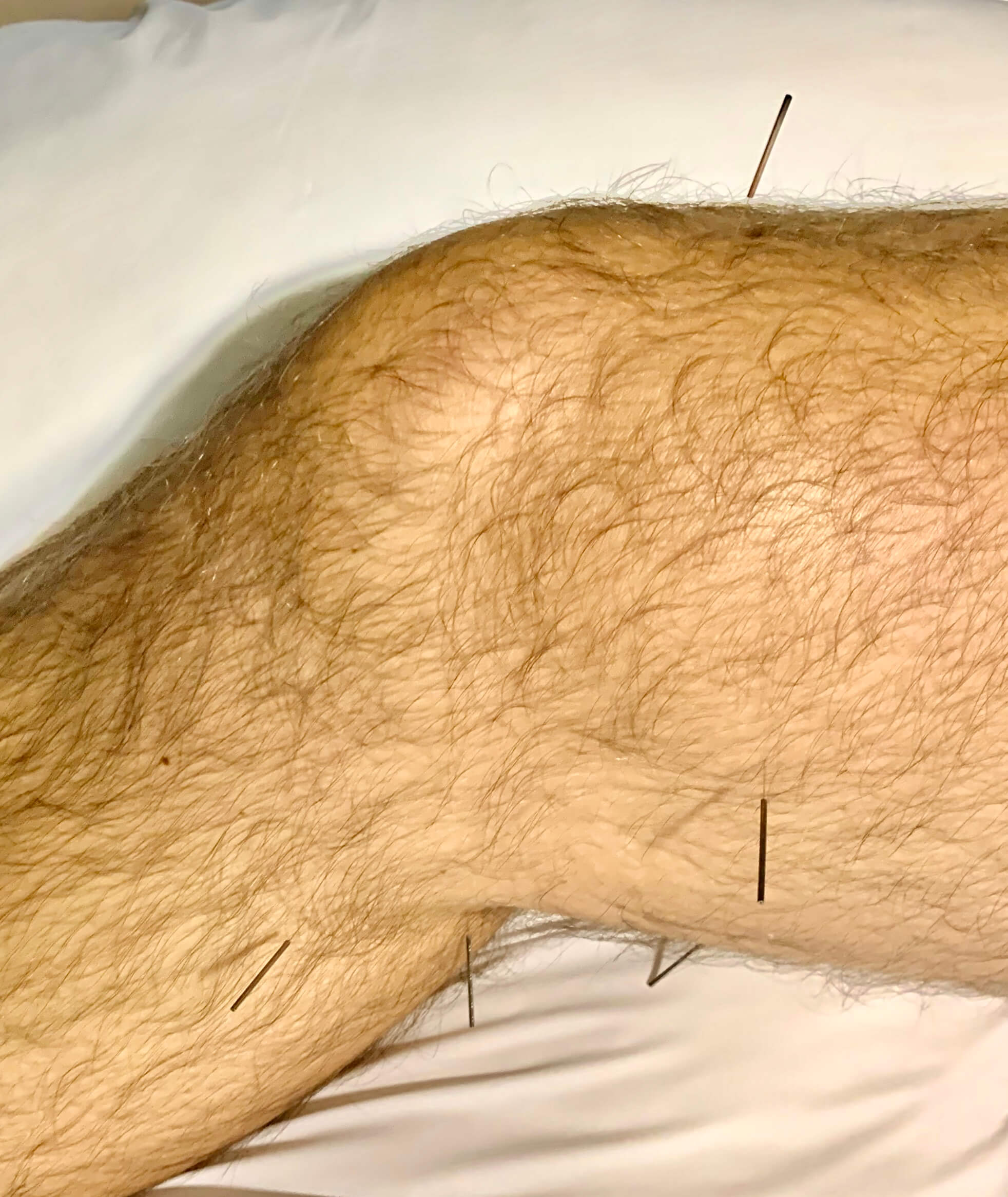 Acupuncture Center Toronto specializing in knee injuries