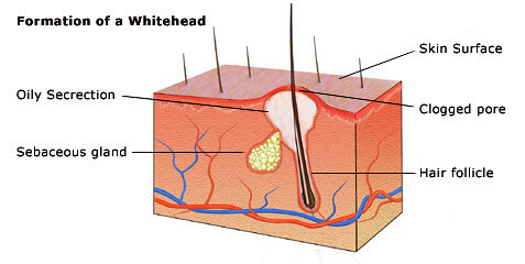 Best Acupuncture and Chinese Herbs for skin problems and acne at Acupuncture Center Toronto