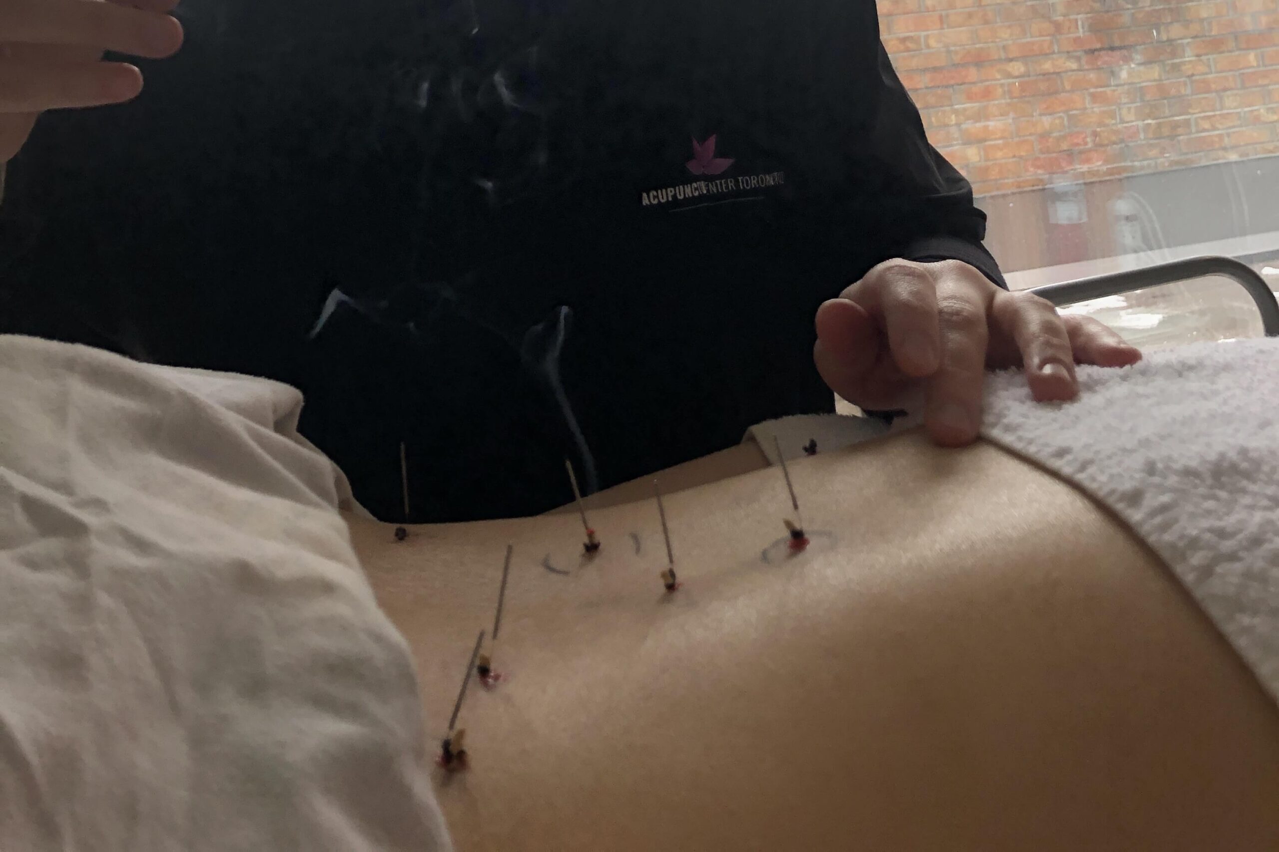 acupuncture and moxibustion for chronic pain relief